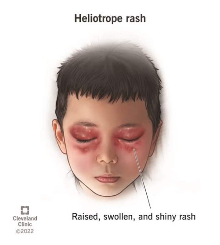 What does the heliotrope sign do?